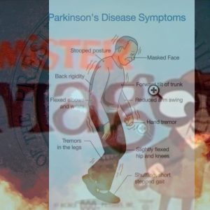 Dementia gate JoJo Magoo  will Fail Parkinson Test & MRI Scan and the Democratic Elite Know it